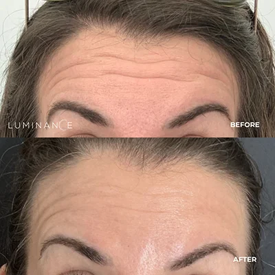 5532-Botox-p01-1