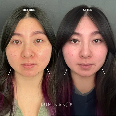 Botox p04-1