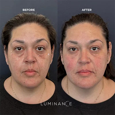 5538-Dermal-Filler-p01-1