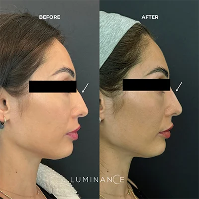 5539-Dermal-Filler-p02-1