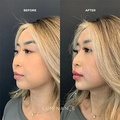 5541-Dermal-Filler-p03-1