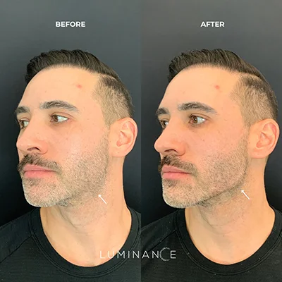 5543-Dermal-Filler-p04-1