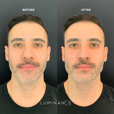 5545-Dermal-Filler-p04-2