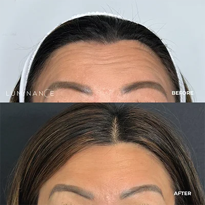 5546-Dermal-Filler-p05-1