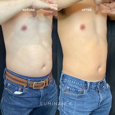 Emsculpt p01-1