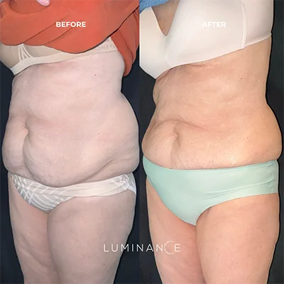 Emsculpt p02-1