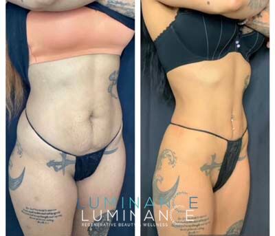 EmsculptNeo-4-treatments-Weight-loss-shots