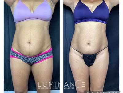 EmsculptNeo-Female-4-treatments