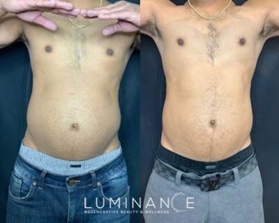 EmsculptNeo-Male-4-treatments