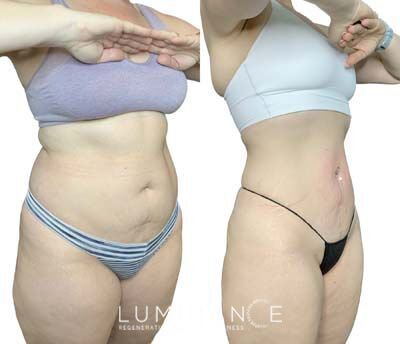 EmsculptNeo-Treated-full-body-20-sessions