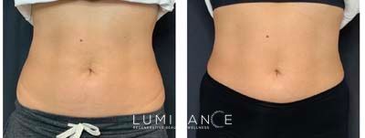 EmsculptNeo_Female-A-4-treatments