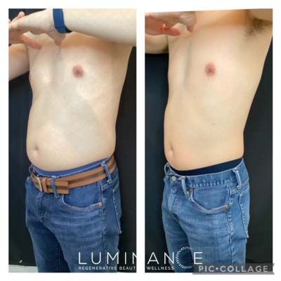 EmsculptNeo_Male-6-Tx