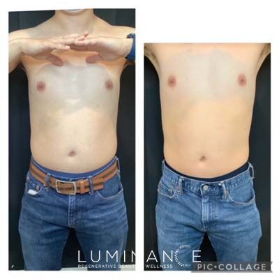 EmsculptNeo_Male-6-treatments