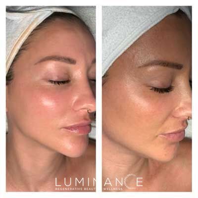 Hydracial-Before_After-1