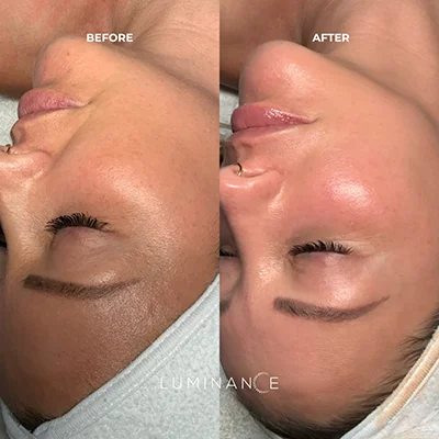 Hydrafacial p1-02