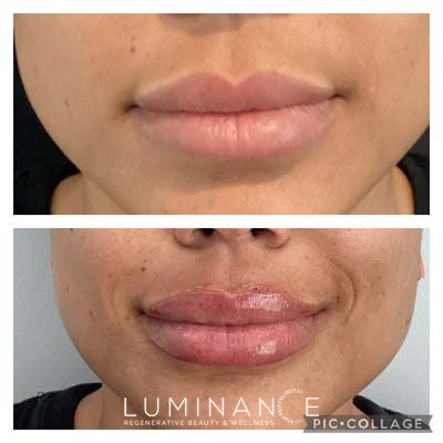 Lip-Filler-Patient-A1