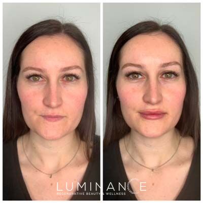 Lip-Filler-Patient-B