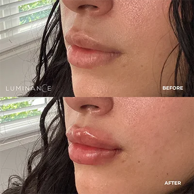 5512-Lip-Filler-p01-1