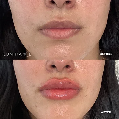 5513-Lip-Filler-p01-2