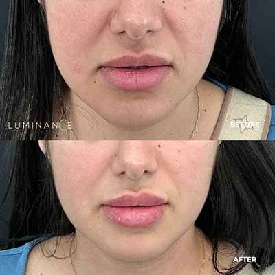 5514-Lip-Filler-p02-1