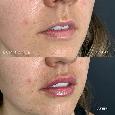 5524-Lip-Filler-p07-1