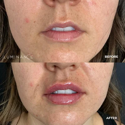 5526-Lip-Filler-p07-2