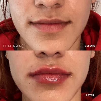 5527-Lip-Filler-p08-1