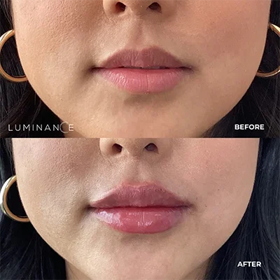 5529-Lip-Filler-p09-1