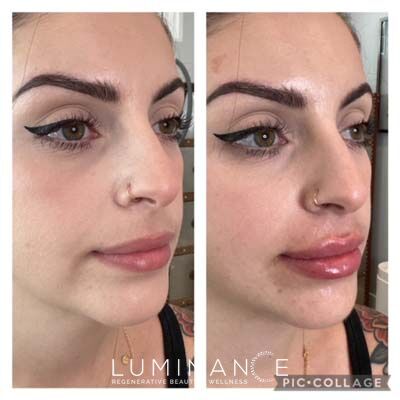 Lip-Filler