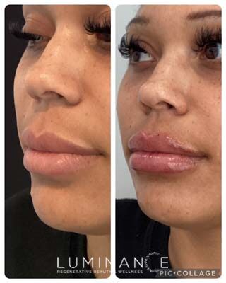 Lip-Filler_Patient-A