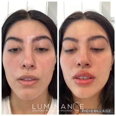 Lip-Filler_Patient-D