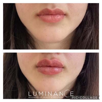 Lip-Filler_Patient-E