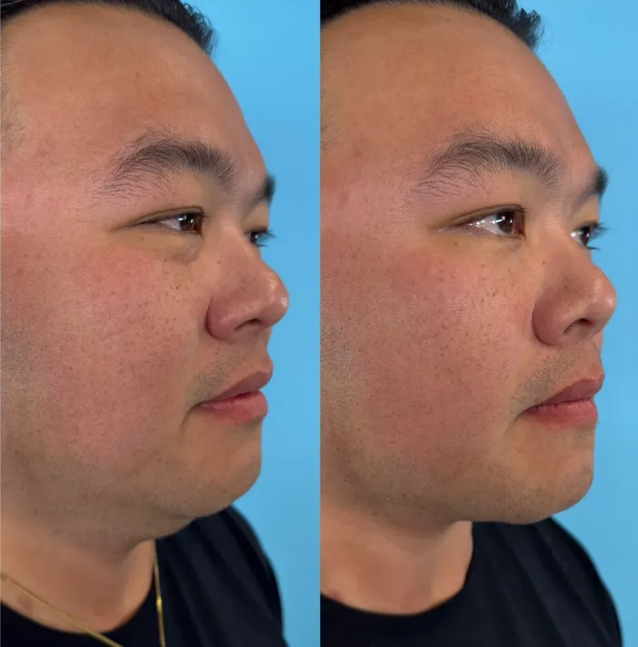 xerf-laser-IMG_7553-1