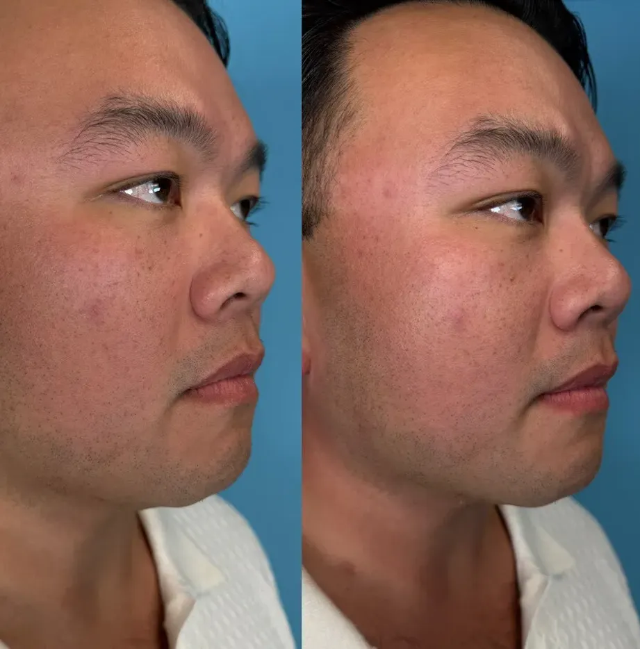 xerf-laser-IMG_7553-2