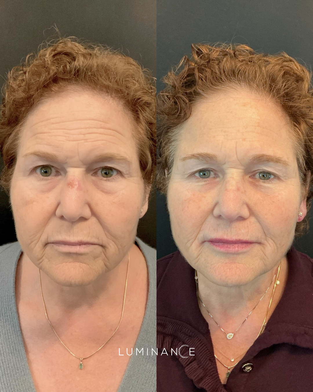 Dermal Filler & Botox