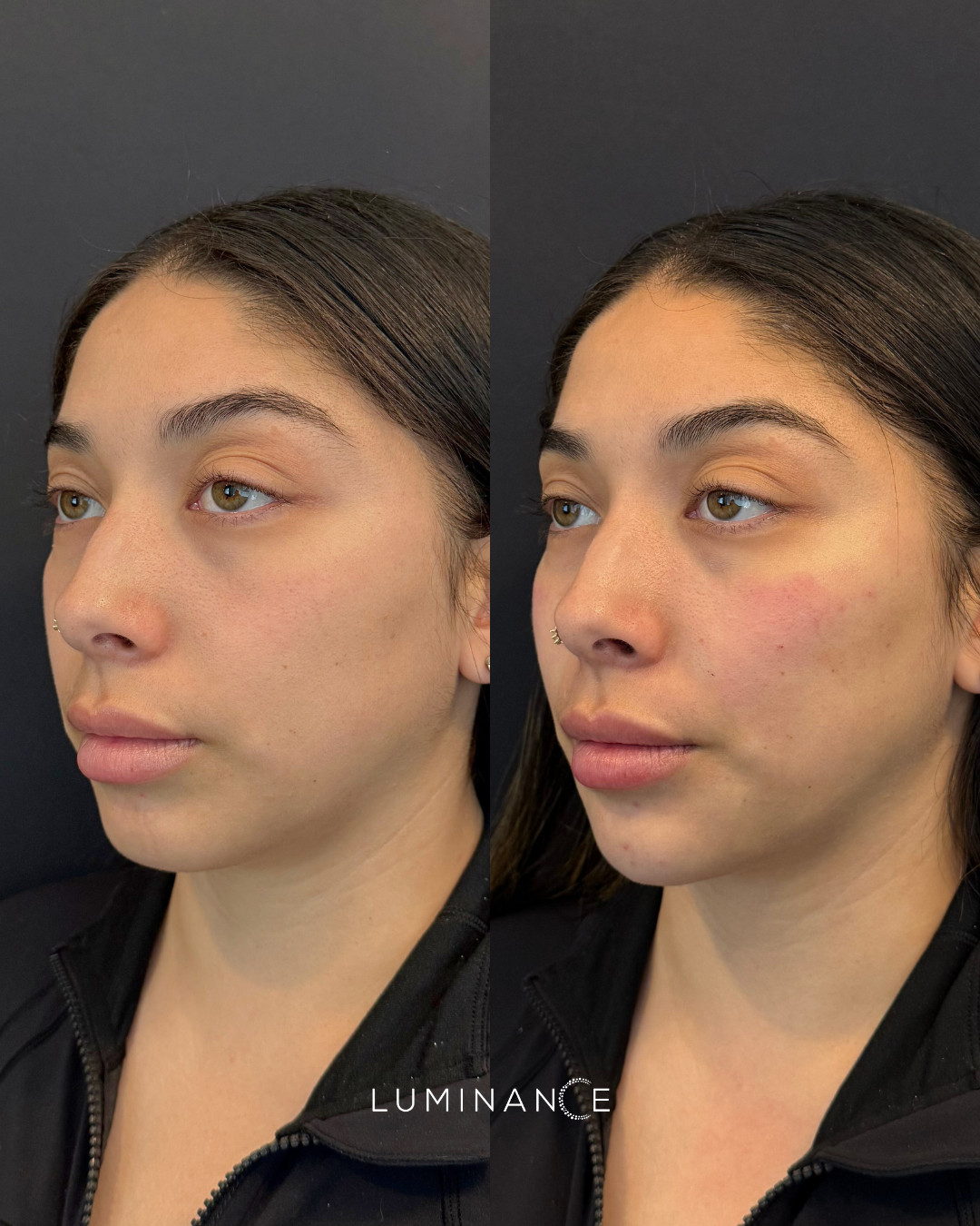 Facial Balancing 2 (Dermal Filler)
