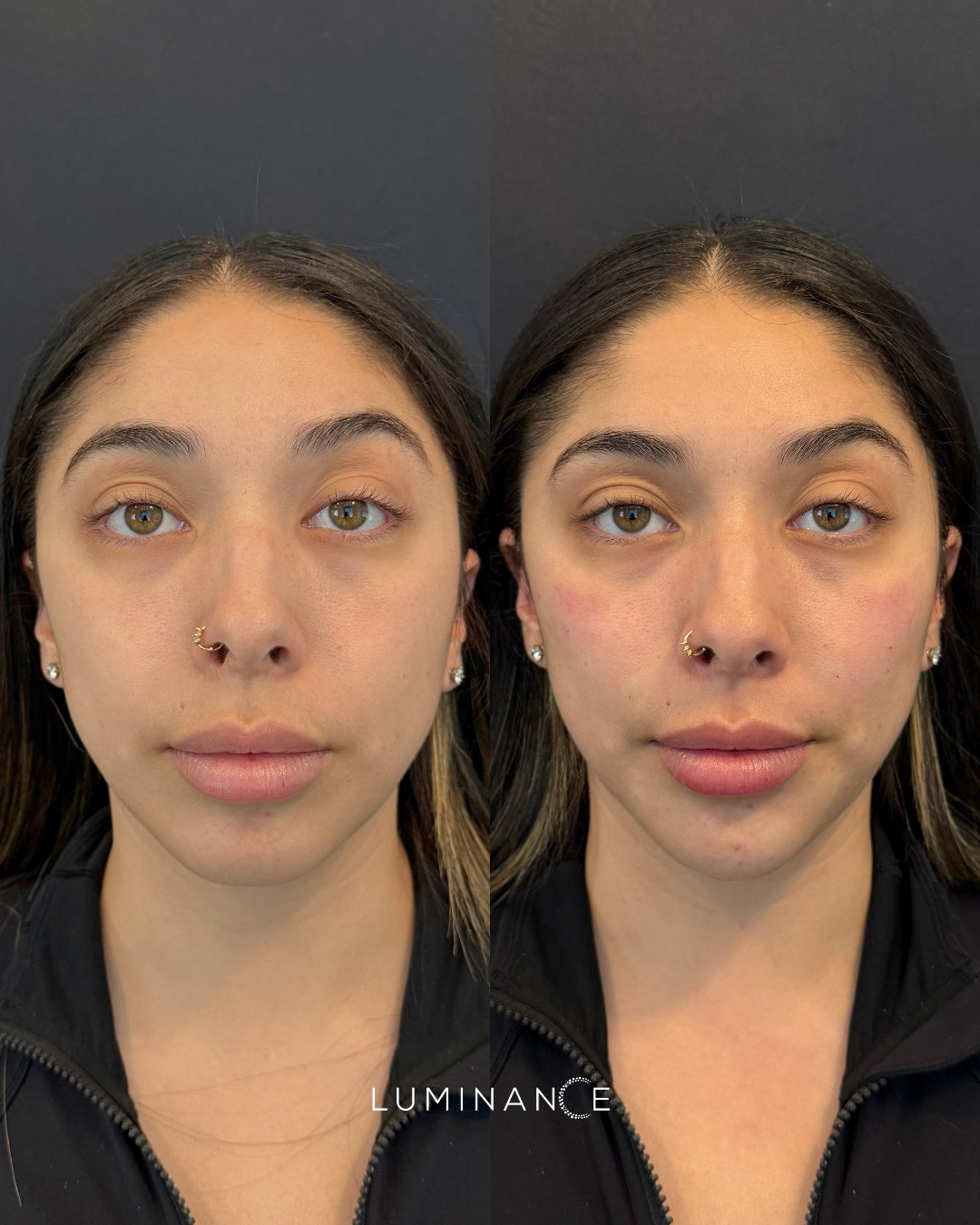 Facial Balancing (Dermal Filler)