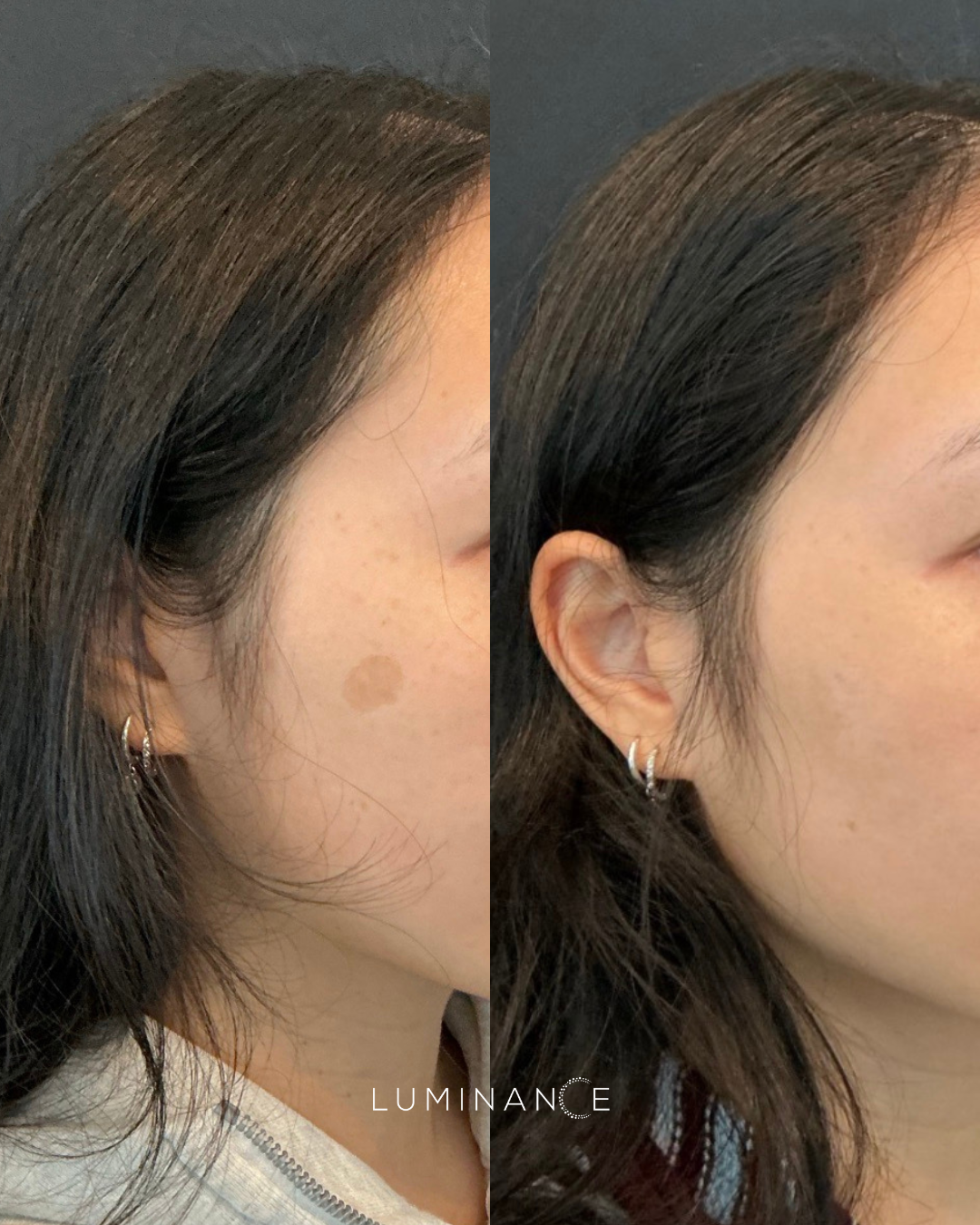 PicoSure Pro